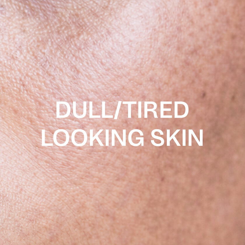 Trött eller glåmig hy