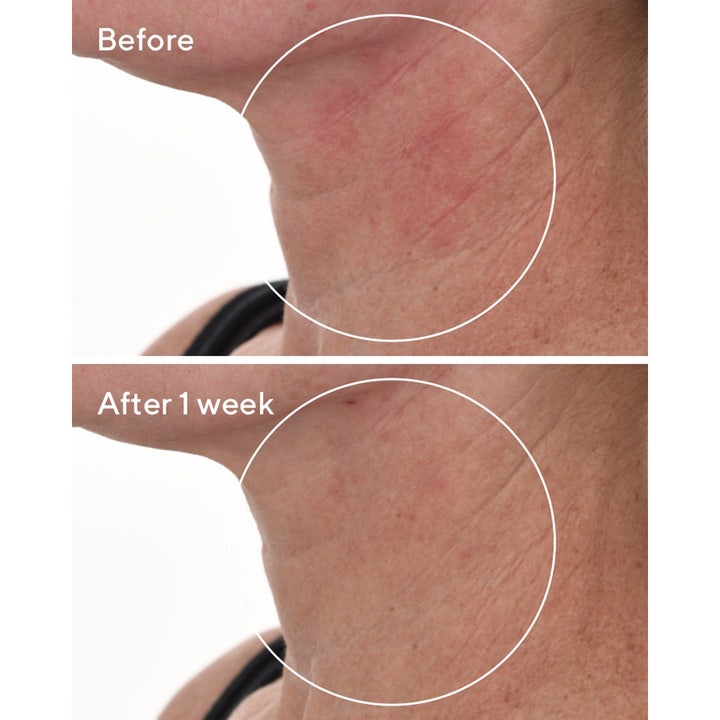 Murad Cellular Hydration Repair Serum 30 ml ger hudreparation och dämpar rodnad på halsen efter en veckas användning.