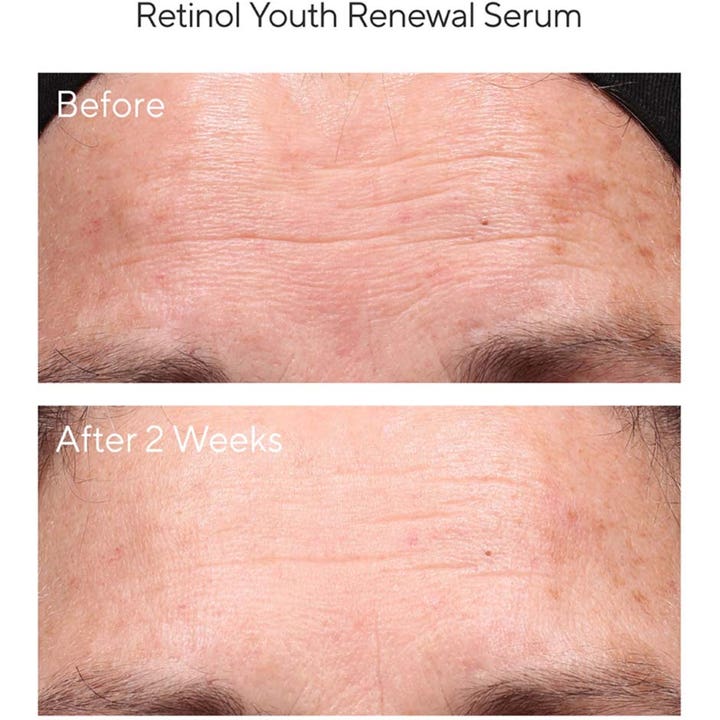 Murad Resurgence Retinol Youth Renewal Serum 30 ml bästa retinol serum för fina linjer visar resultat efter två veckor.