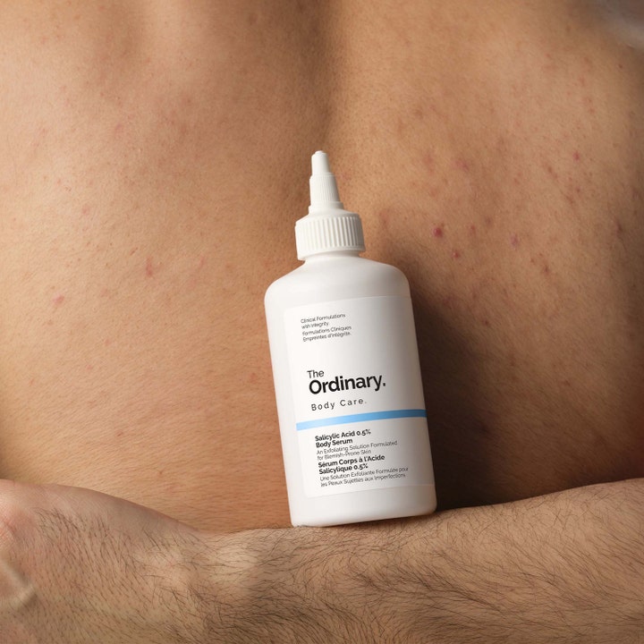 The Ordinary Salicylic Acid 0.5% Body Serum 240 ml exfolierande kroppsserum i vit flaska mot en rygg med blemmor