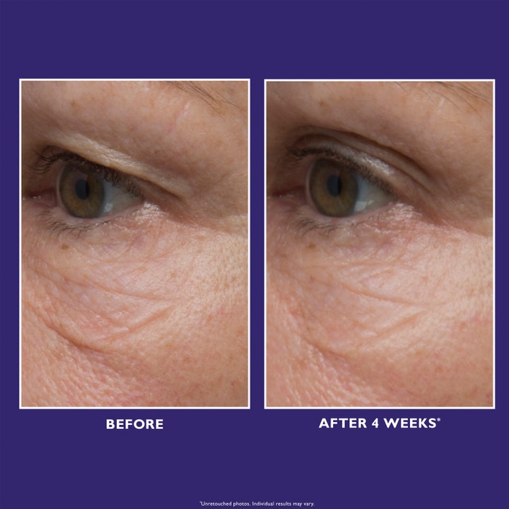 Peter Thomas Roth Ultimate Solution 5™ Eye Cream 15 ml ögonkräm peptider visar Before och After 4 Weeks resultat.