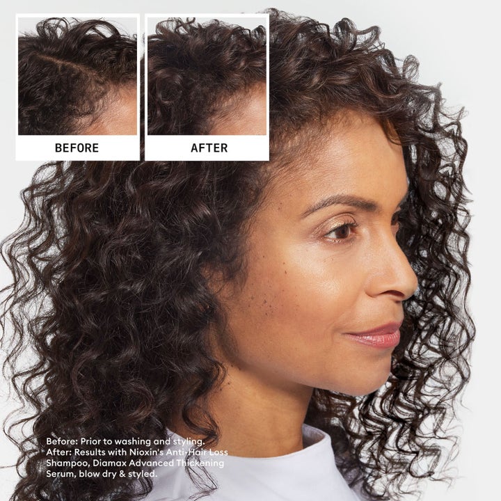 Hair Loss Defence System