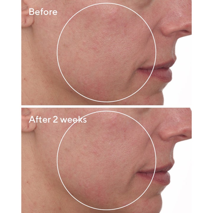 Murad Cellular Hydration Repair Cream 50 ml visar före- och efterresultat på hud med minskad rodnad.