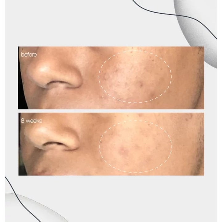 Dermalogica PowerBright Dark Spot Serum Duo med niacinamid visar före och efter resultat på pigmentfläckar efter 8 veckor.