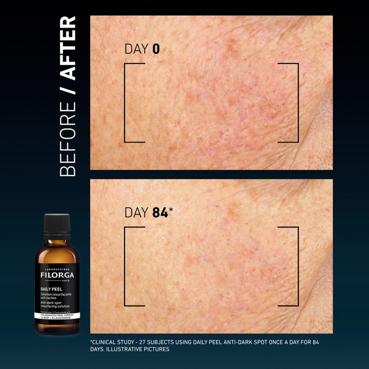 Filorga Clinical Home Peel Dark Spot 50 ml peeling mot mörka fläckar visar resultat före och efter 84 dagar