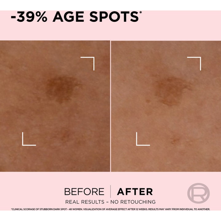 L'Oréal Paris Age Perfect serum mot åldersfläckar 30 ml visar före och efter resultat med -39% synliga åldersfläckar.