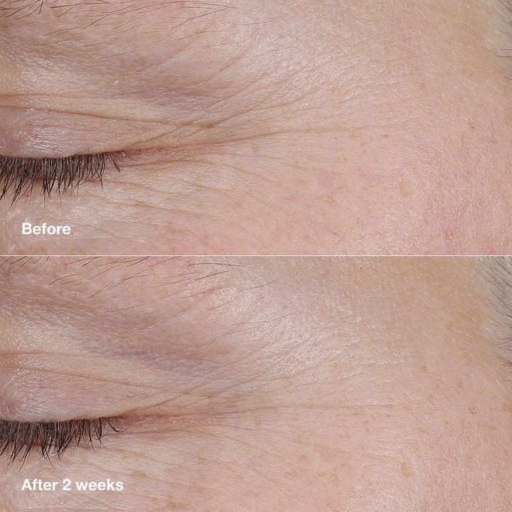 Clinique Smart Clinical Repair Retinoid Balm 3 g före och efter bild som visar rynkborttagning ansiktskräm resultat.