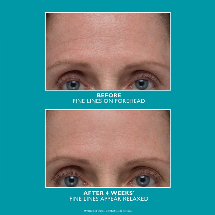 Peter Thomas Roth Peptide Skinjection 30 ml rynkreducerande serum med peptider visar före och efter bilder på pannrynkor.