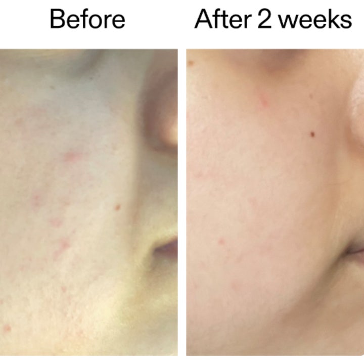 The INKEY List 360 Skin Clearing Serum 30 ml ansiktsserum visar före och efter resultat med klarare hy efter två veckor.