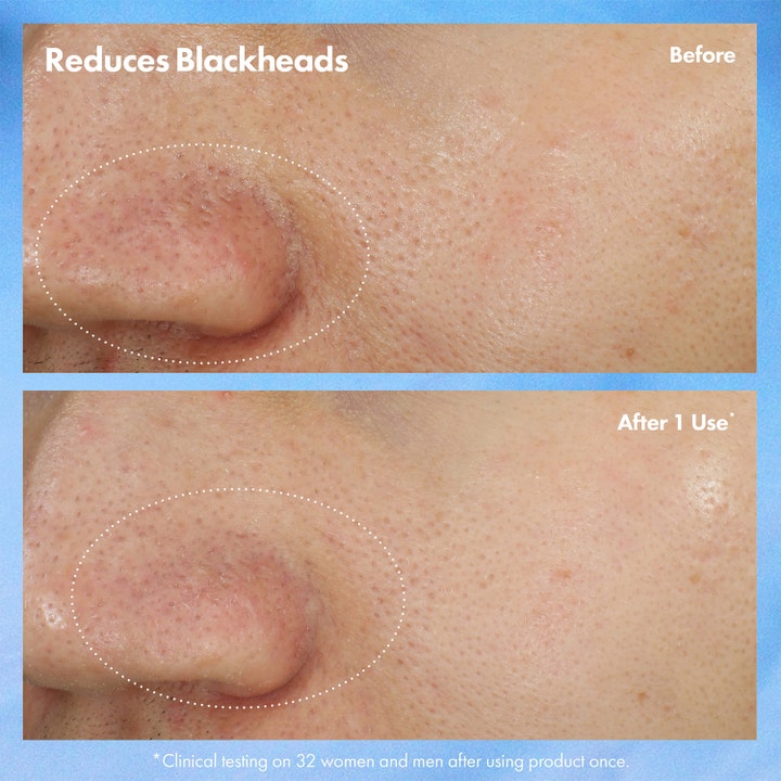 Origins Clear Improvement 75 ml 2-i-1 ansiktsmask och skrubb visar före och efter resultat på pormaskar