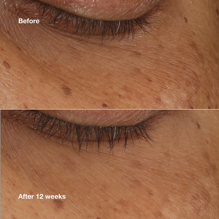 Clinique All About Eyes Brightening Serum Concentrate 10 ml ögonserum visar hudens förbättring före och efter 12 veckor
