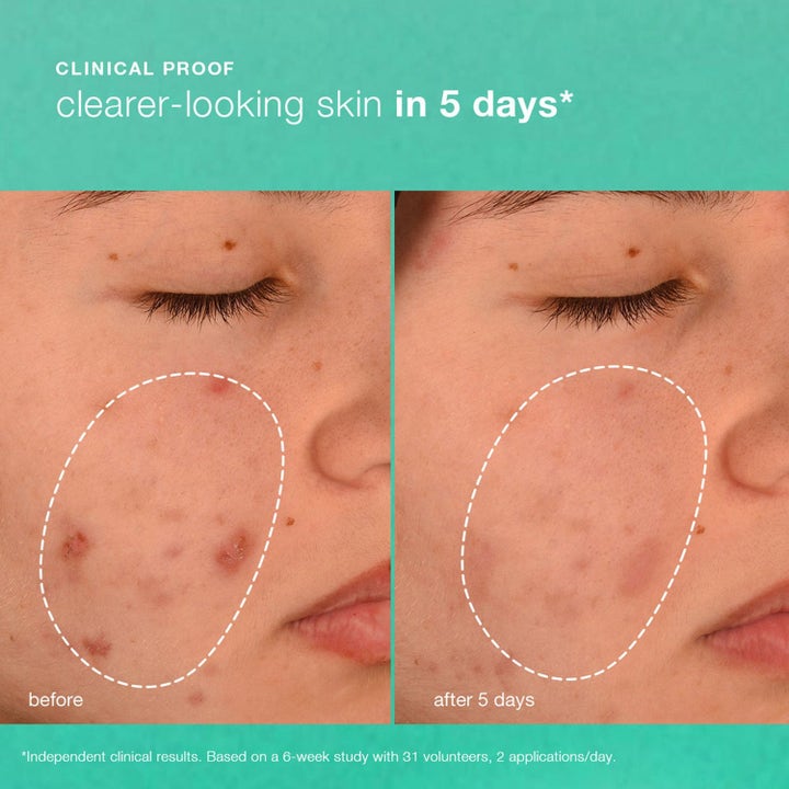 Dermalogica Breakout Biotic Moisturizer Duo visar före och efter resultat för klarare hy på fem dagar.