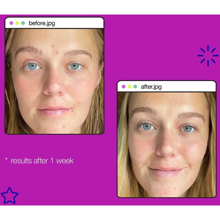 Dermalogica Post-Breakout Fix Duo 2x 15 ml salicylsyra visar hy med före och efter resultat efter en vecka.