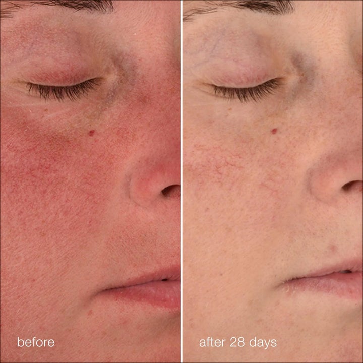 Dermalogica Stabilizing Repair Cream Duo hudvård som lugnar rödhet före och efter 28 dagars användning.