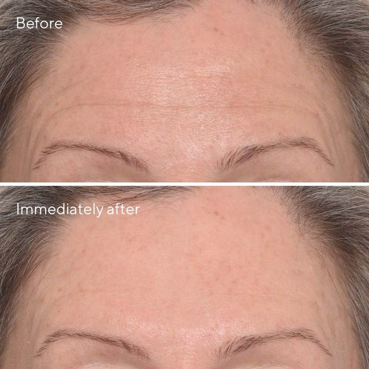 Murad Resurgence Targeted Wrinkle Corrector 15 ml ger anti-age rynkreducering visat med före och efter resultat