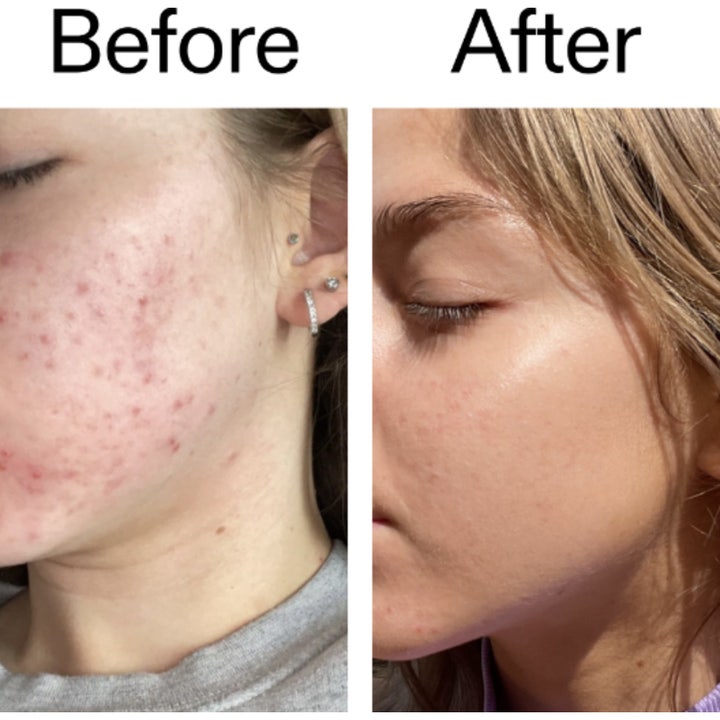The INKEY List Beta Hydroxy Acid Serum 30 ml bha exfoliering för fet hy med genomskinlig geltextur