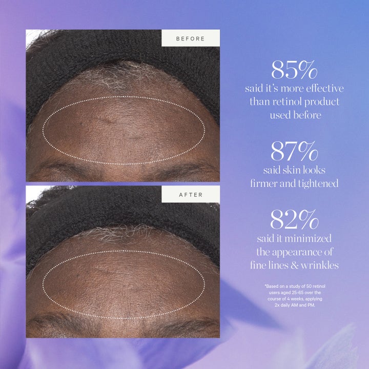 KORA Organics Plant Stem Cell Retinol 50 ml anti-age visar 82% färre rynkor i före och efter resultat.
