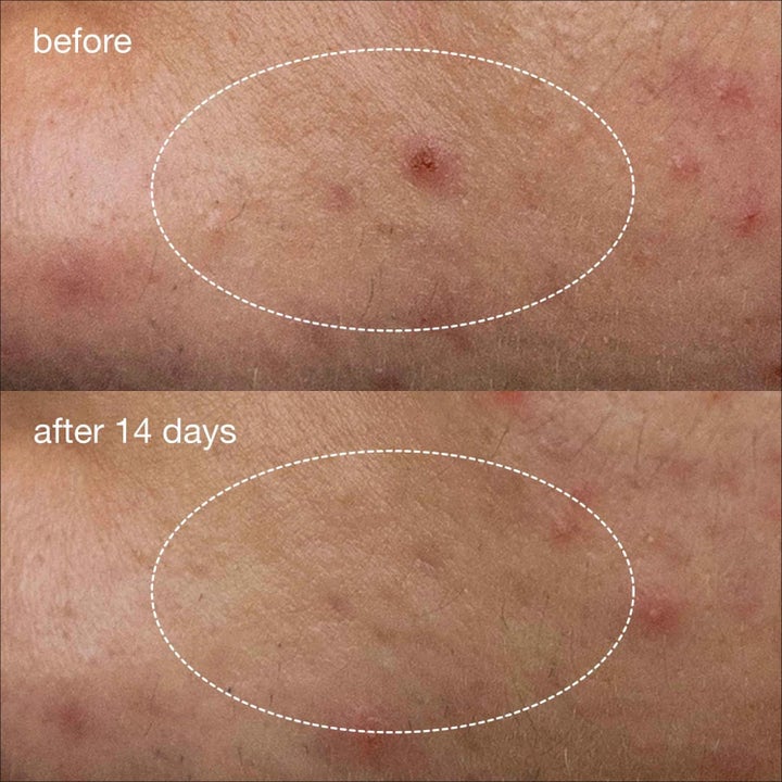 Dermalogica Deep Acne Liquid Patch Duo 2x15 ml niacinamid hudvård visar före och efter 14 dagar mot finnar.