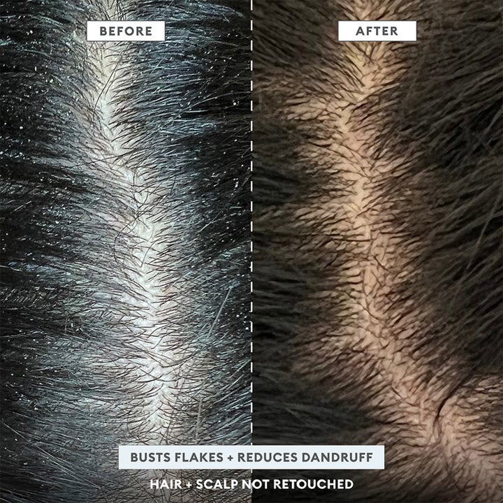 Scalp Revival™ Dandruff Relief Shampoo