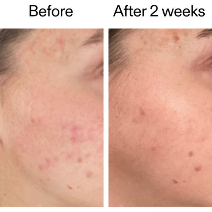 The INKEY List 360 Skin Clearing Serum 30 ml ansiktsserum före och efter som visar minskad rodnad och blemmor