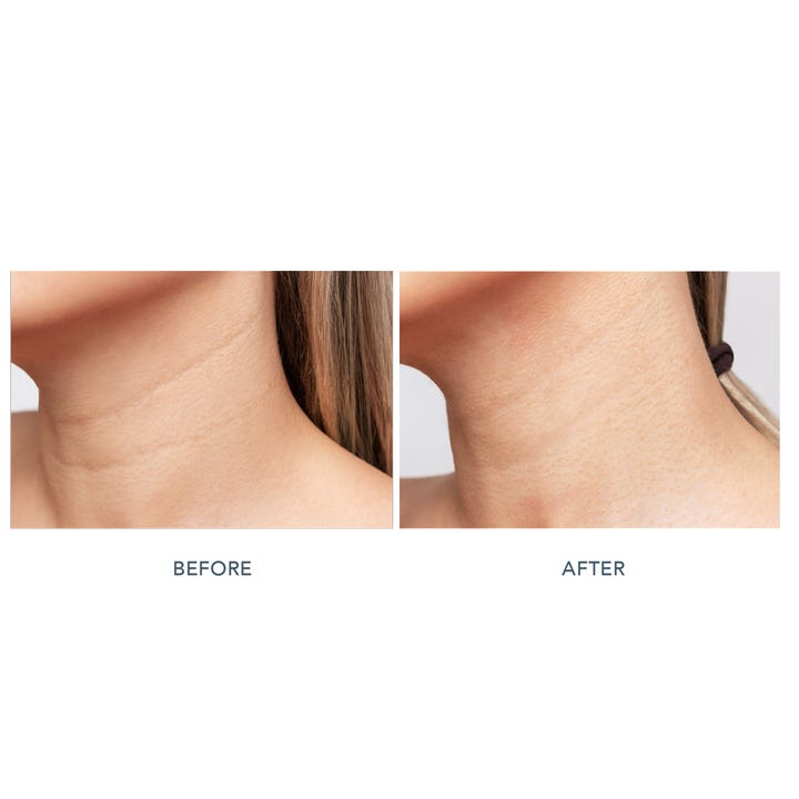 FAQ Swiss FAQ 211 LED Neck & Décolleté Mask ger LED rynkbehandling hemma visat med före och efter bilder på halsen.