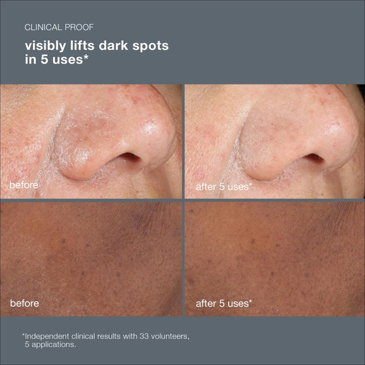 Dermalogica PowerBright Dark Spot Peel 50 ml peeling visar före och efter resultat på pigmentfläckar.