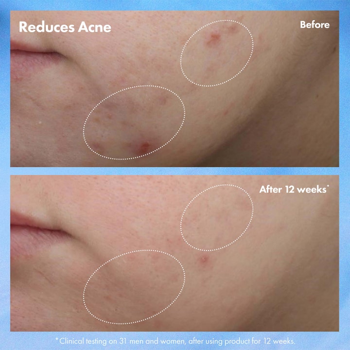 Origins Clear Improvement Blemish Clearing Hydrating Lotion 50 ml dagkräm visar resultat mot acne efter 12 veckor.