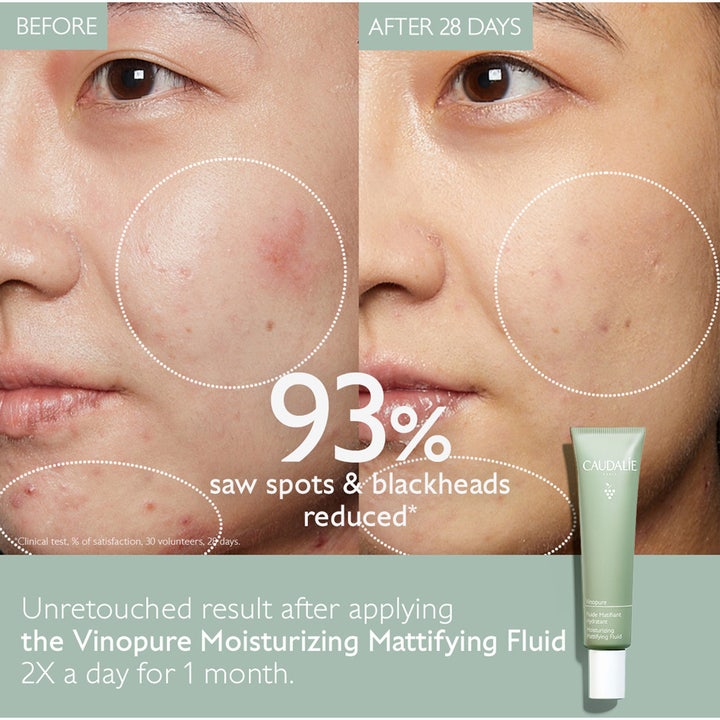 Caudalie Vinopure Moisturizing Mattifying Fluid 40 ml fuktkräm för blandhy före och efter resultat på akne
