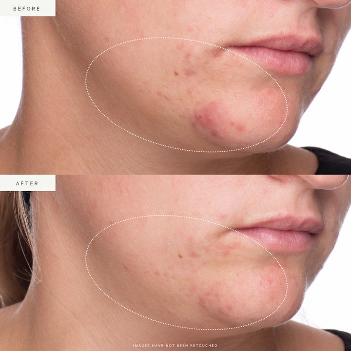 KORA Organics Active Algae Lightweight Moisturizer 50 ml ekologisk ansiktskräm visar före och efter resultat på rodnad