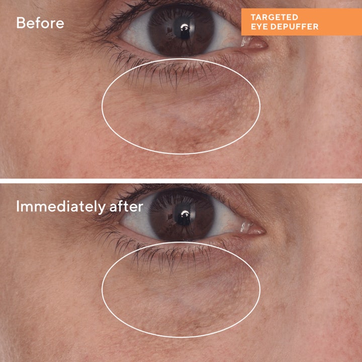 Murad Targeted Eye Depuffer 15 ml ögonkräm svullna ögon visar före- och efterbilder på reducerade påsar under ögat.