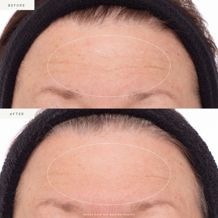 KORA Organics Plant Stem Cell Retinol Alternative Serum 30 ml före och efter resultat med bakuchiol anti-aging serum