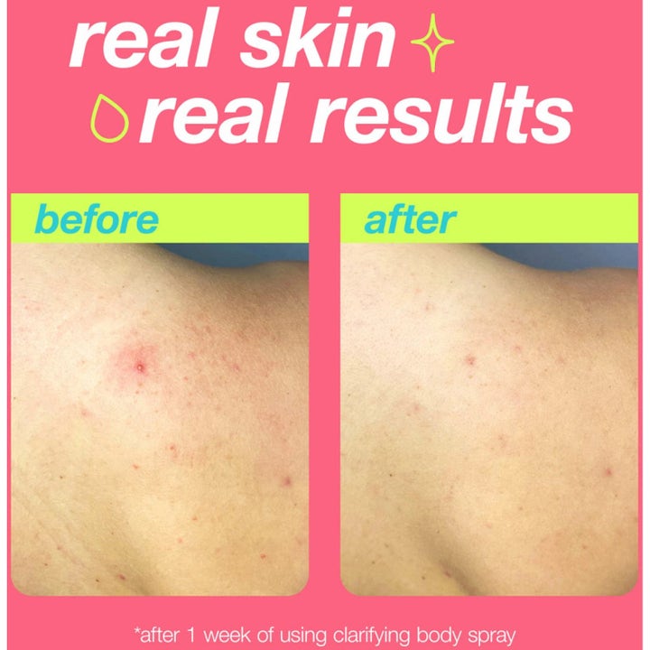 Dermalogica Clarifying Body Spray visar före och efter resultat mot orenheter med salicylsyra för klarare hud.