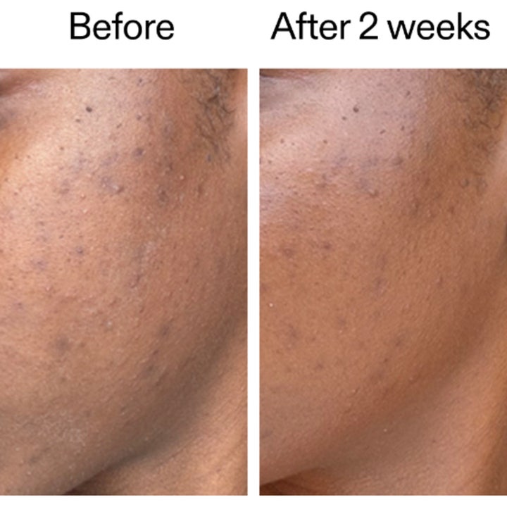 The INKEY List 360 Skin Clearing Serum 30 ml mot orenheter visar synliga resultat på huden efter två veckor