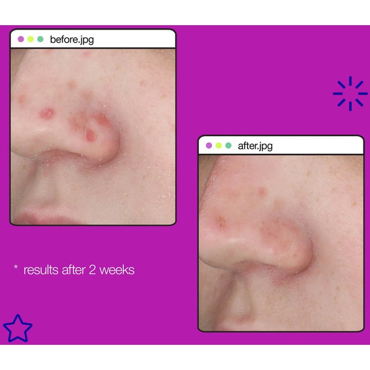 Dermalogica Post-Breakout Fix 15 ml fläckblekning visar före- och efterbilder med resultat efter två veckor