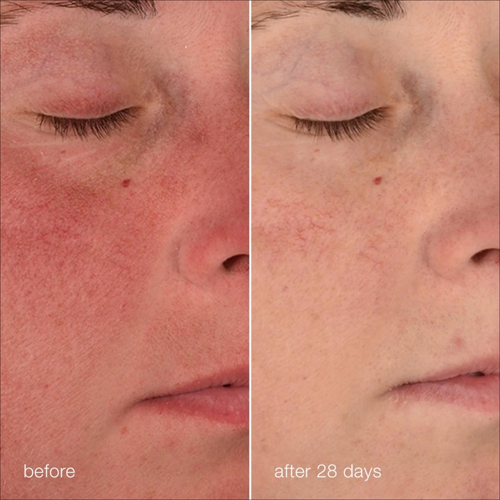 Dermalogica Stabilizing Repair Cream 50 ml barriärkräm ansikte anti-rodnad visar synlig effekt efter 28 dagar.