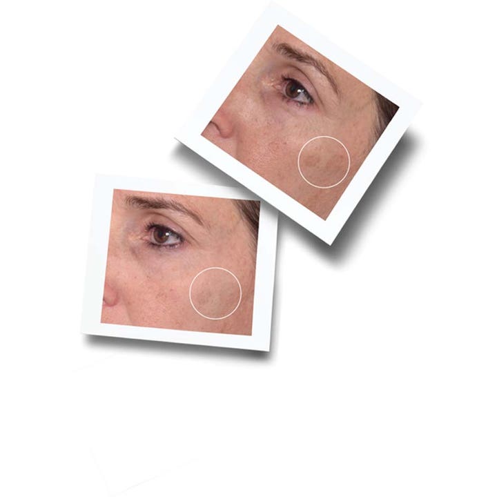 Murad Environmental Shield Rapid Dark Spot Correcting Serum 30 ml mot pigmentering ansikte visar närbilder på mörka fläckar.