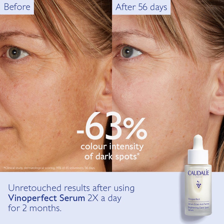Caudalie Vinoperfect Radiance Serum 30 ml behandling pigmentfläckar visar före och efter resultat på mörka fläckar.