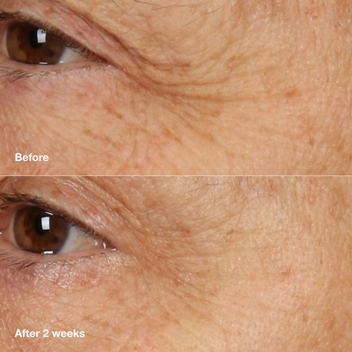 Clinique Smart Clinical Repair 50 ml anti-aging nattkräm före och efter två veckor på rynkor vid ögat.
