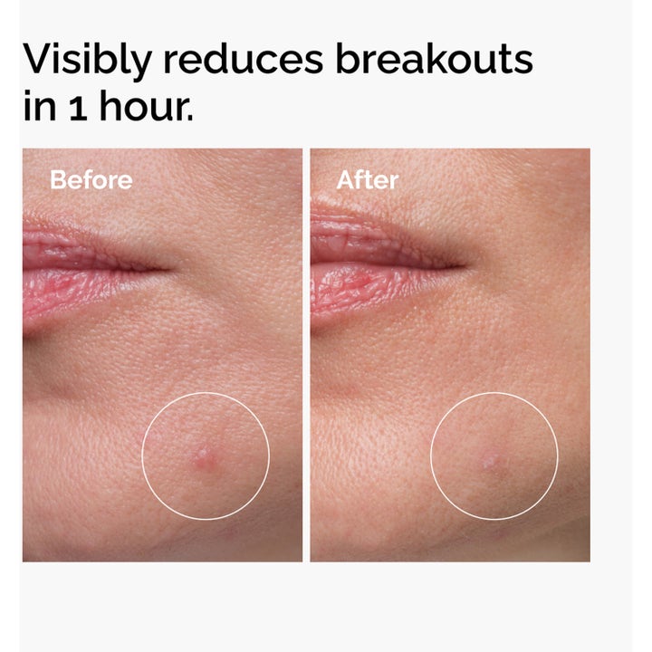 The Ordinary Sulfur 10% Powder-To-Cream 5 g spot treatment före och efter resultat på finne på hakan