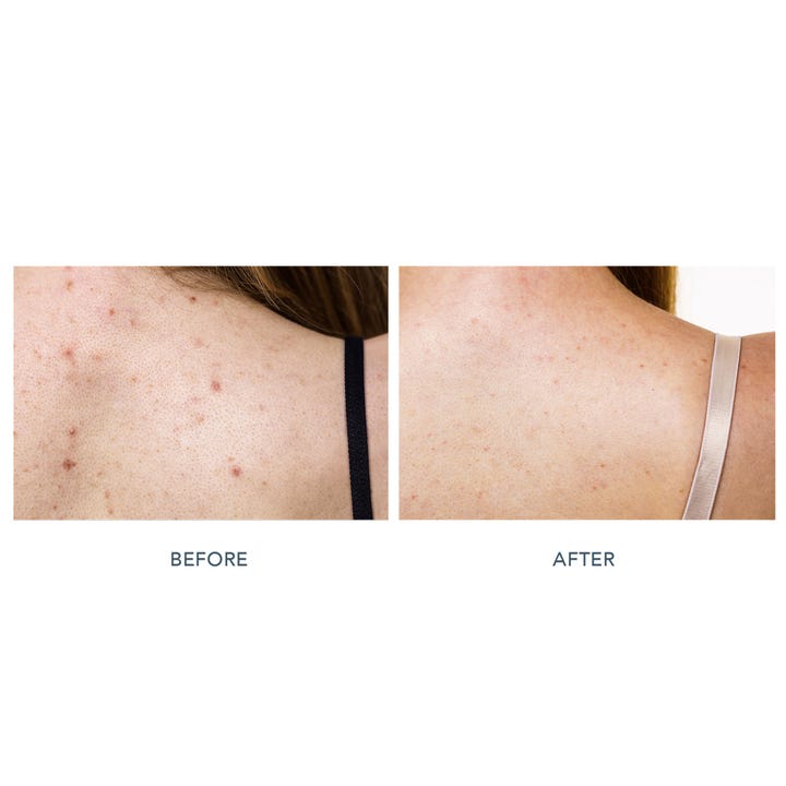 FAQ Swiss FAQ 211 LED Neck & Décolleté Mask 1 st led-mask visar före och efter resultat med minskade orenheter.