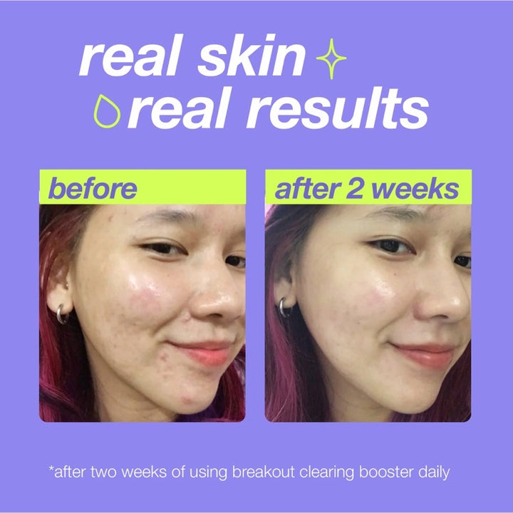 Dermalogica Clear Start Booster Set hudvård visar före och efter resultat på hy med orenheter efter två veckor.